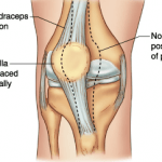 Patellar Dislocations