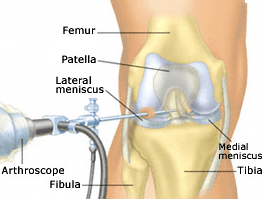 Arthroscopic Repair of the Knee