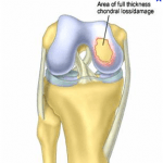 Chondral Defects