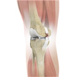 Other Knee Ligament Injuries