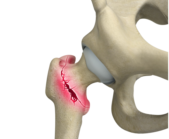 Hip Injuries & Conditions