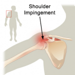 Shoulder Impingement