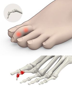  Claw Toe   