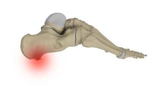 Heel Spurs 
