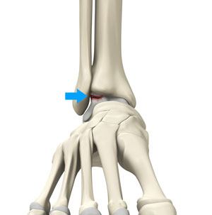  Osteochondral Injuries of the Ankle   