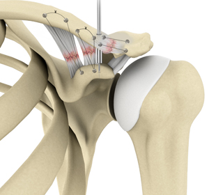 AC Joint Repair img