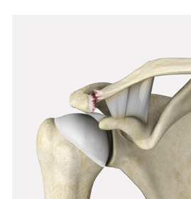 AC Joint Separation - Picture