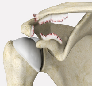 AC Joint Separation img