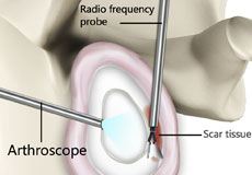 Capsular Release img