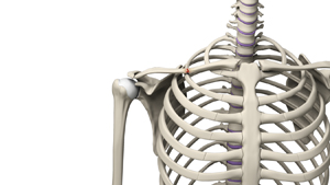 Clavicle Fracture - Picture
