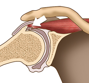 Internal Impingement of the Shoulder img