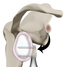 Latarjet Procedure - Picture