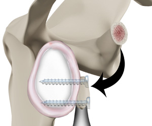 Latarjet Procedure img