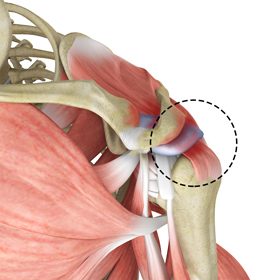 Rotator Cuff Pain - Picture