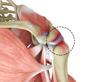 Rotator Cuff Pain img