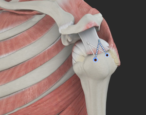 Rotator Cuff Repair - Picture