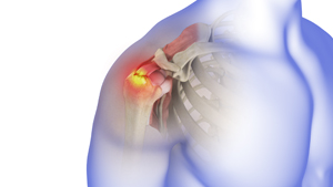 Rotator Cuff Tear - Picture