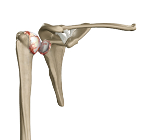 Shoulder Arthritis Surgery - Picture