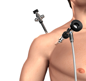 Shoulder Arthroscopy - Picture