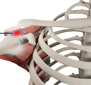 Shoulder Bursitis img
