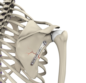 Shoulder Fracture Care - Picture