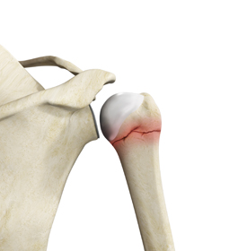 Shoulder Fracture - Picture
