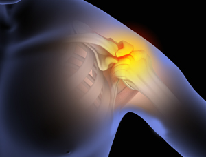 Shoulder Impingement - Picture