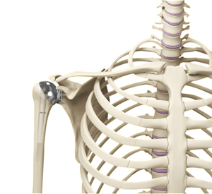 Shoulder Joint Replacement - Picture
