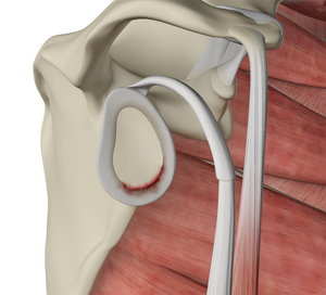Shoulder Labral Tear - Picture