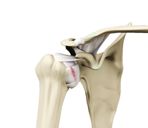 Shoulder Ligament Injuries - Picture