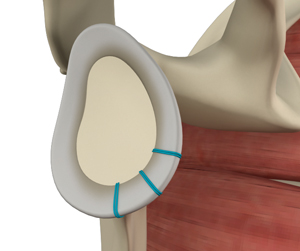 Shoulder Stabilization - Picture