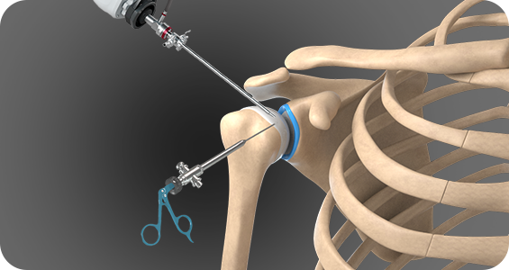 Shoulder Arthroscopy - Picture