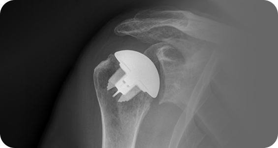Total Shoulder Replacement - Picture
