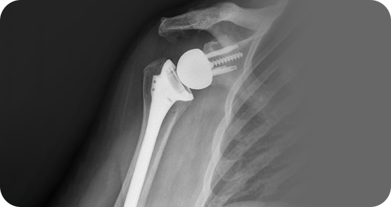Reverse Shoulder Replacement - Picture