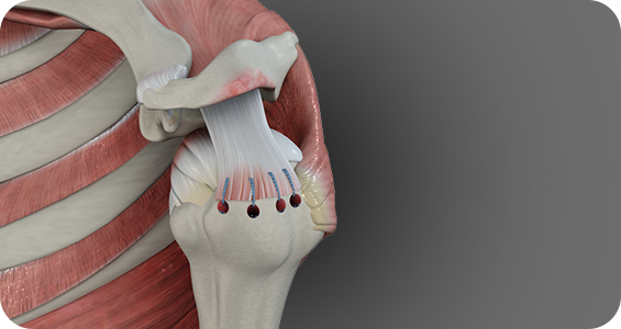 Rotator Cuff Repair - Picture