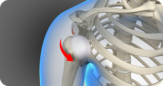 Treatment of Shoulder Instability/dislocation - Picture