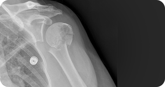 Treatment of Shoulder Fractures - Picture