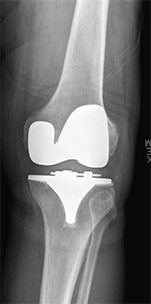  Revision Knee Replacement 