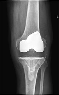  Revision Knee Replacement 