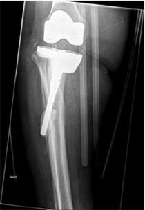 Revision Hip Replacement