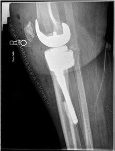 Revision Hip Replacement