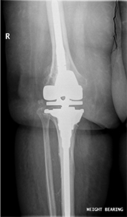 Revision Hip Replacement