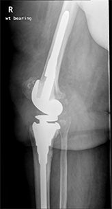 Revision Hip Replacement