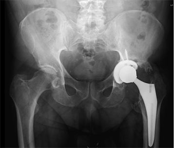 Revision Hip Replacement