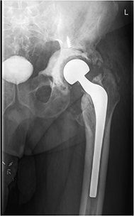 Revision Hip Replacement
