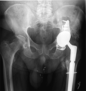 Revision Hip Replacement