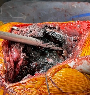 Revision Hip Replacement