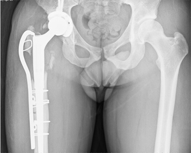 Revision Hip Replacement
