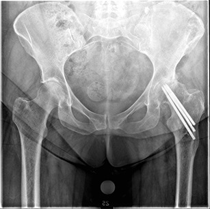 Total Hip Replacement