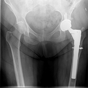 Total Hip Replacement